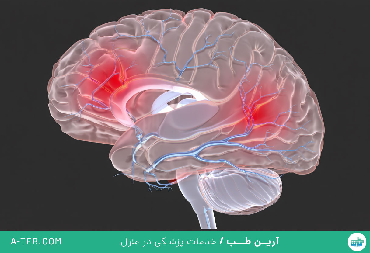 خونریزی مغزی ناشی از ضربه