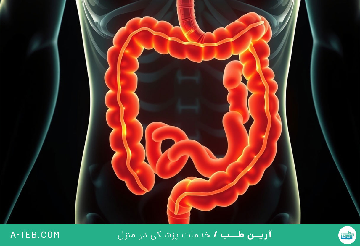 سندروم روده تحریک پذیر