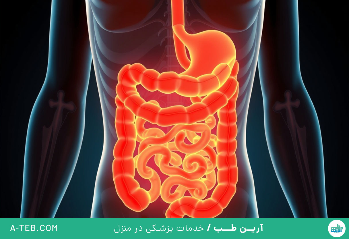 سندروم روده تحریک پذیر