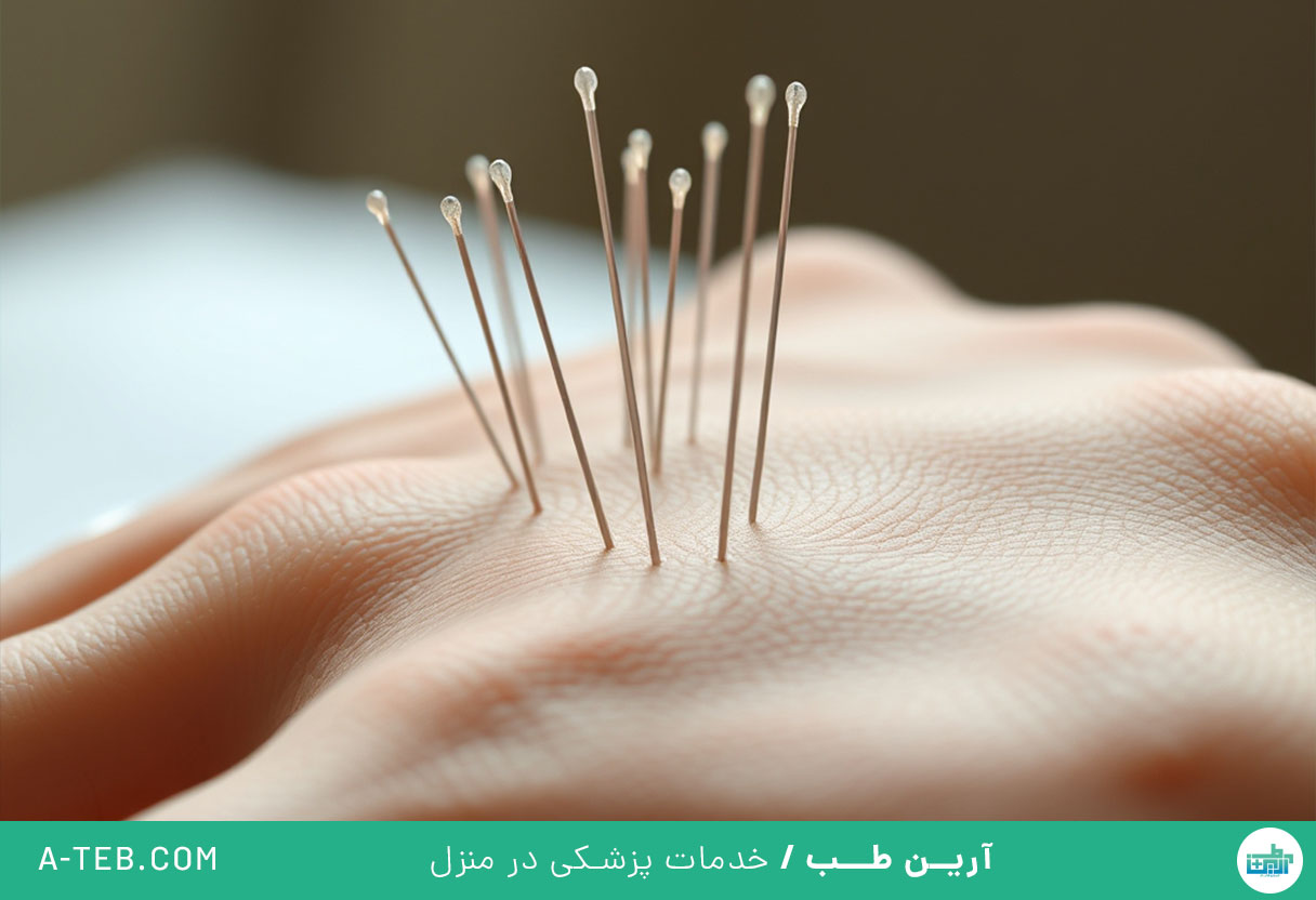 طب سوزنی در منزل شمال تهران