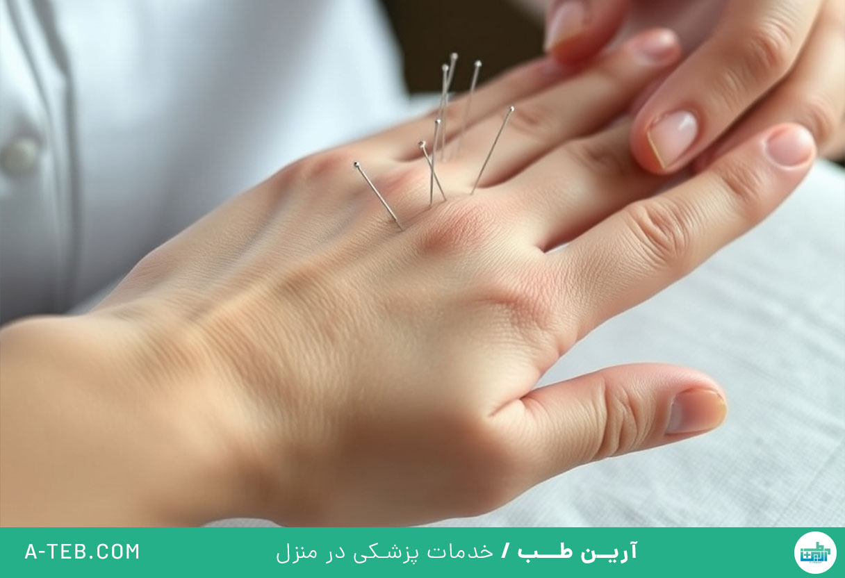 طب سوزنی در منزل شمال تهران