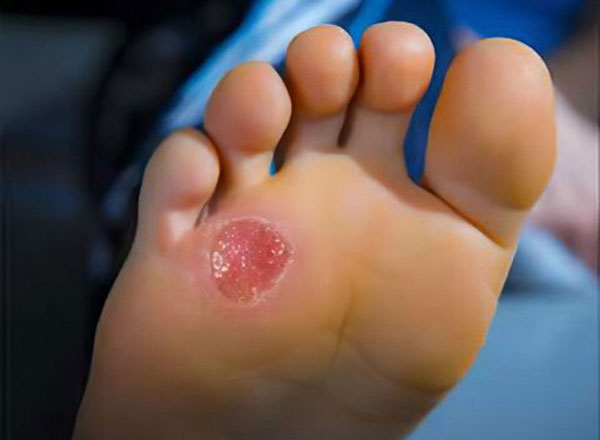 درمان زخم دیابتی در منزل