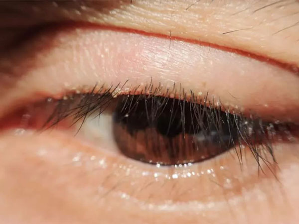 علت بلفاریت چشم