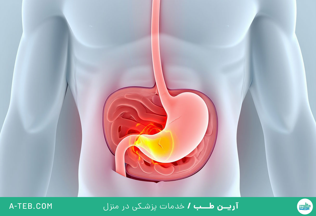 رفلاکس معده