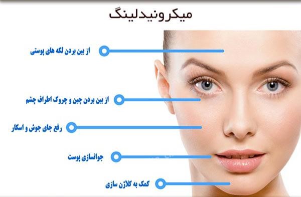 میکرونیدلینگ