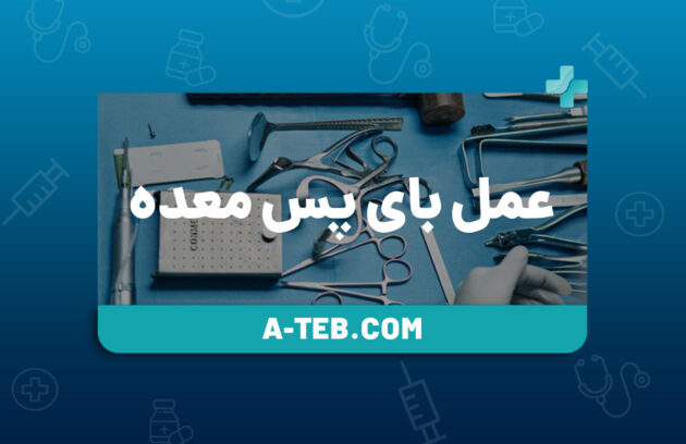 عمل بای پس معده