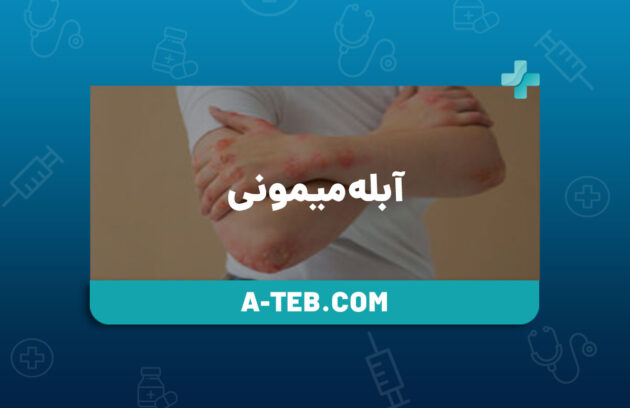 آبله میمونی