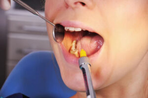 دلیل آبسه دندان چیست