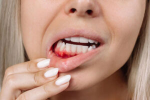 آنتی بیوتیک برای آبسه دندان