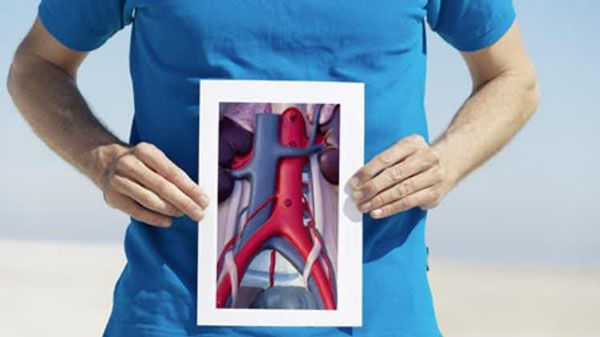 آنوریسم آئورت