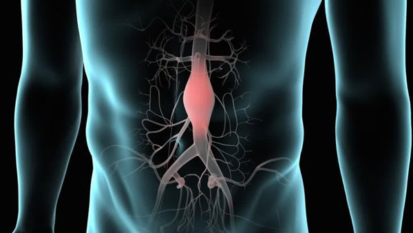 علائم آنوریسم آئورت