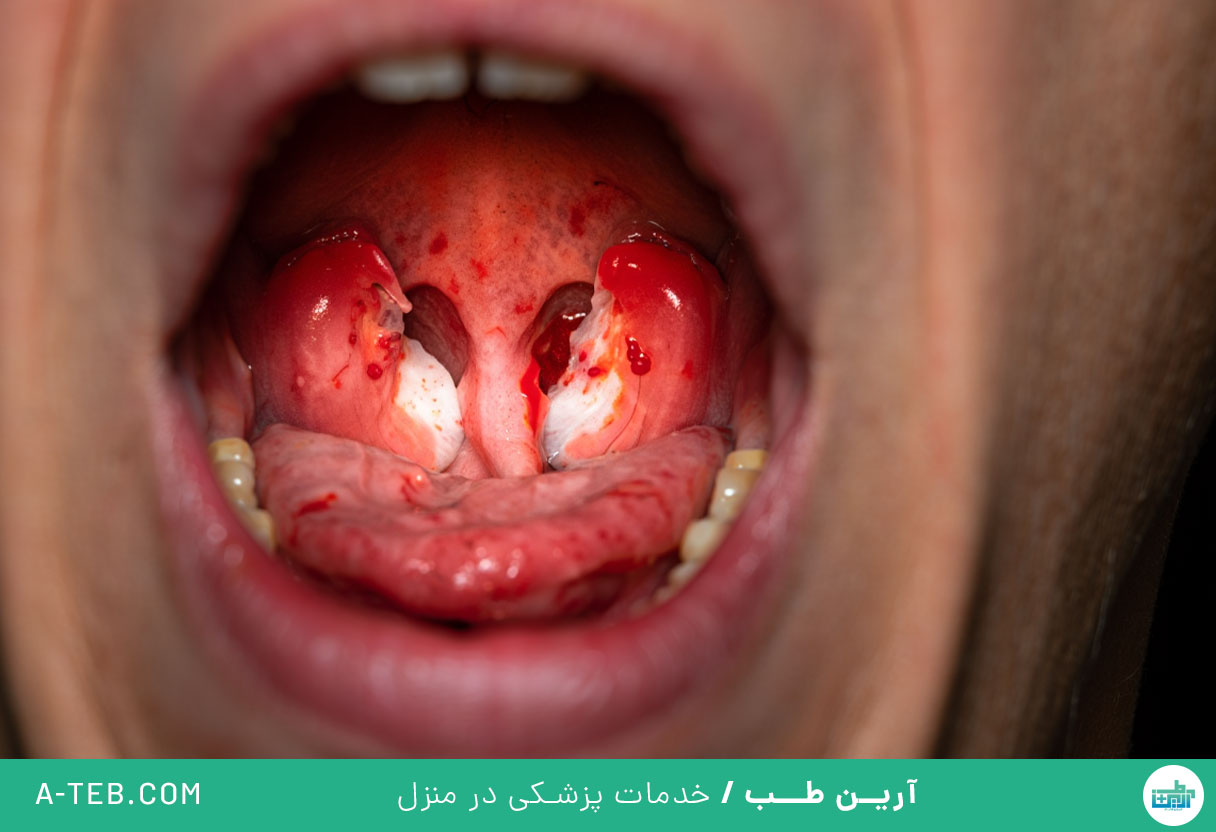 عفونت گلو