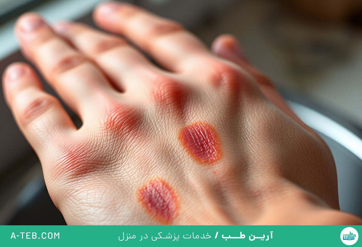 سوختگی با آب جوش