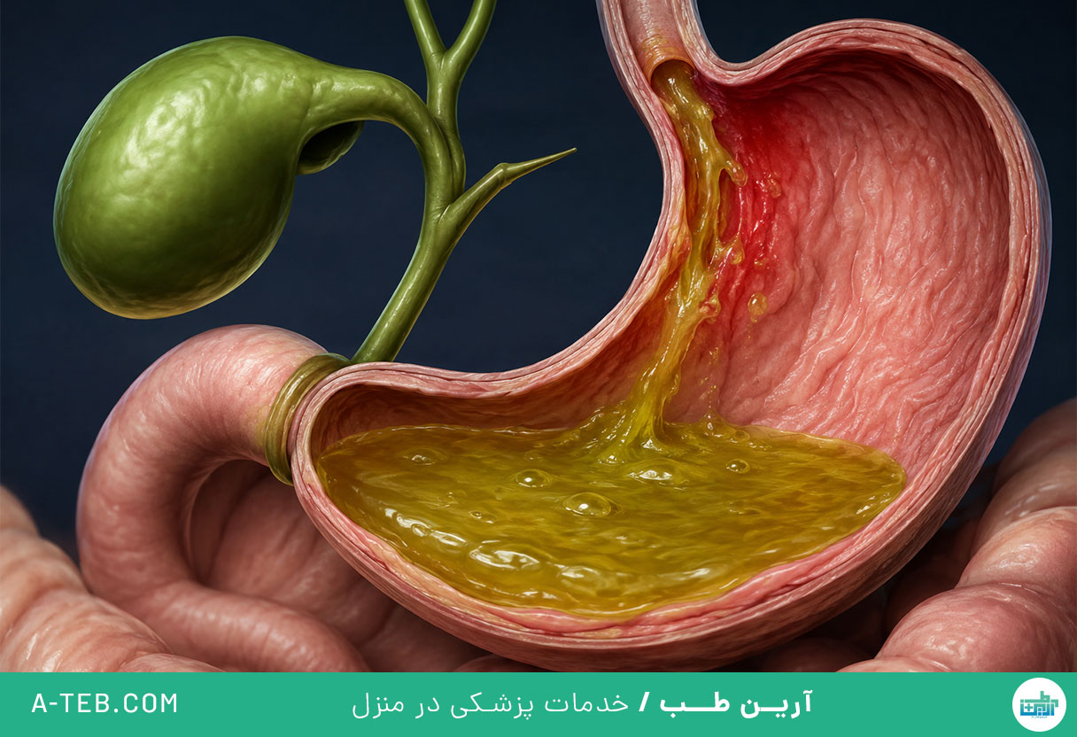 ریفلاکس صفراوی