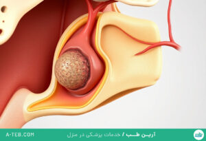 سرطان حنجره