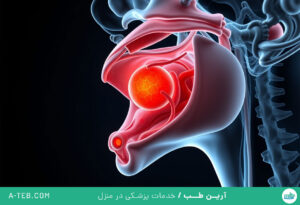 سرطان حنجره