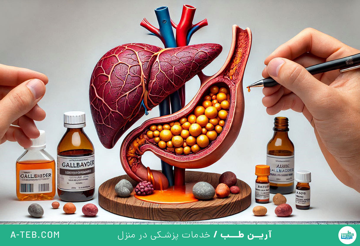 سنگ کیسه صفرا