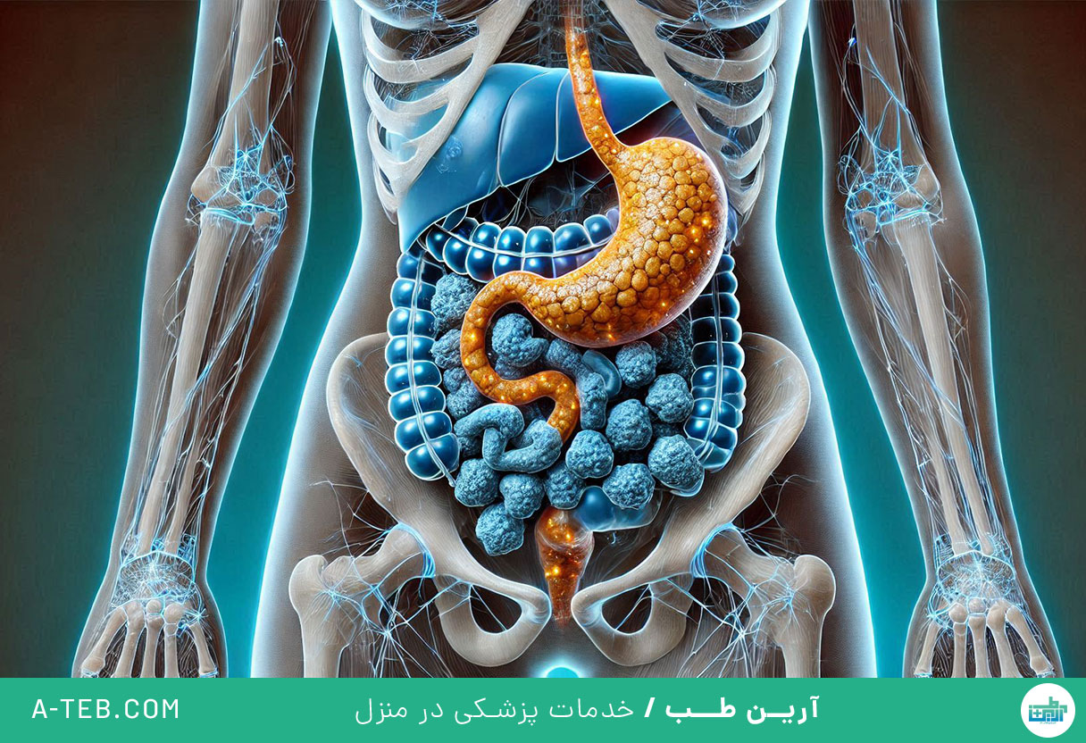 سنگ کیسه صفرا
