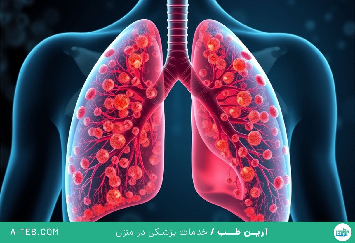 عفونت ریه