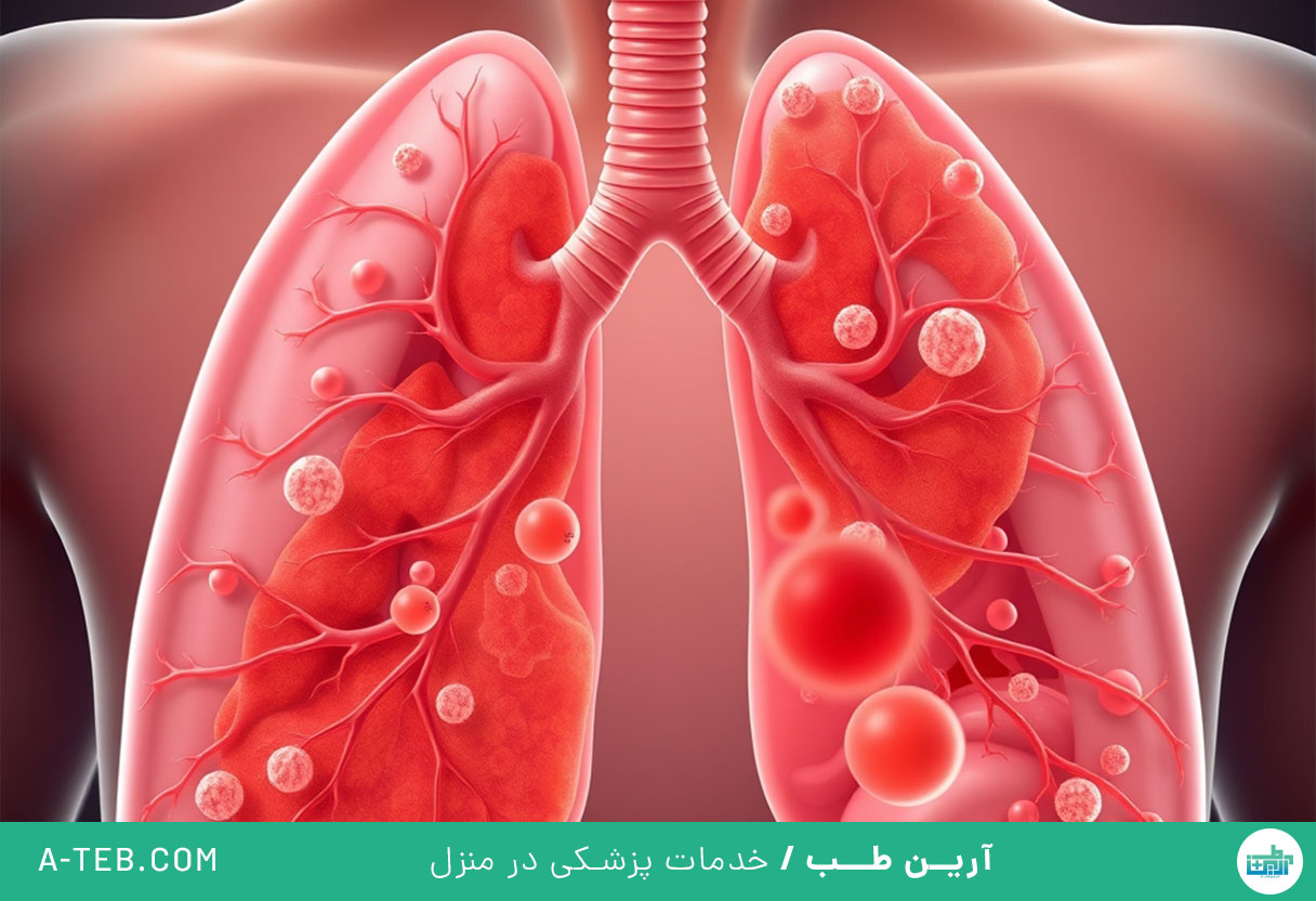 عفونت ریه