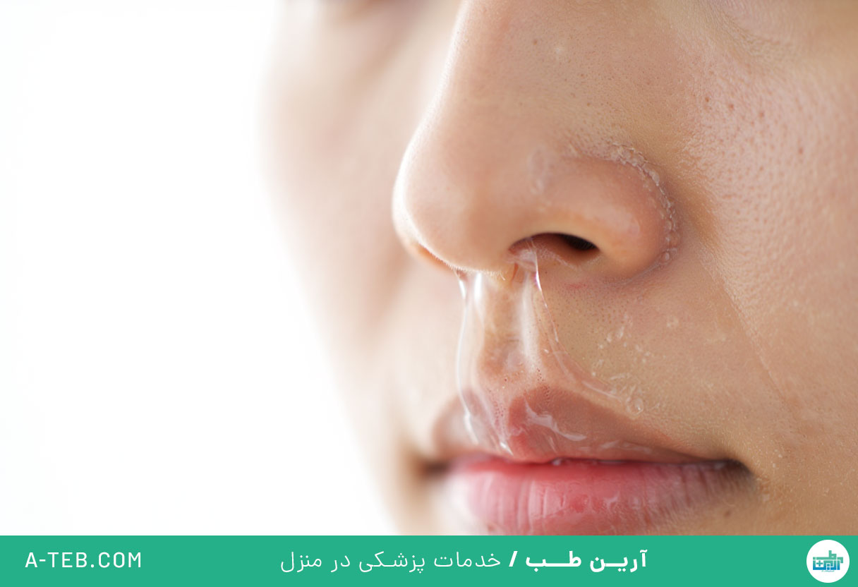 آبریزش بینی
