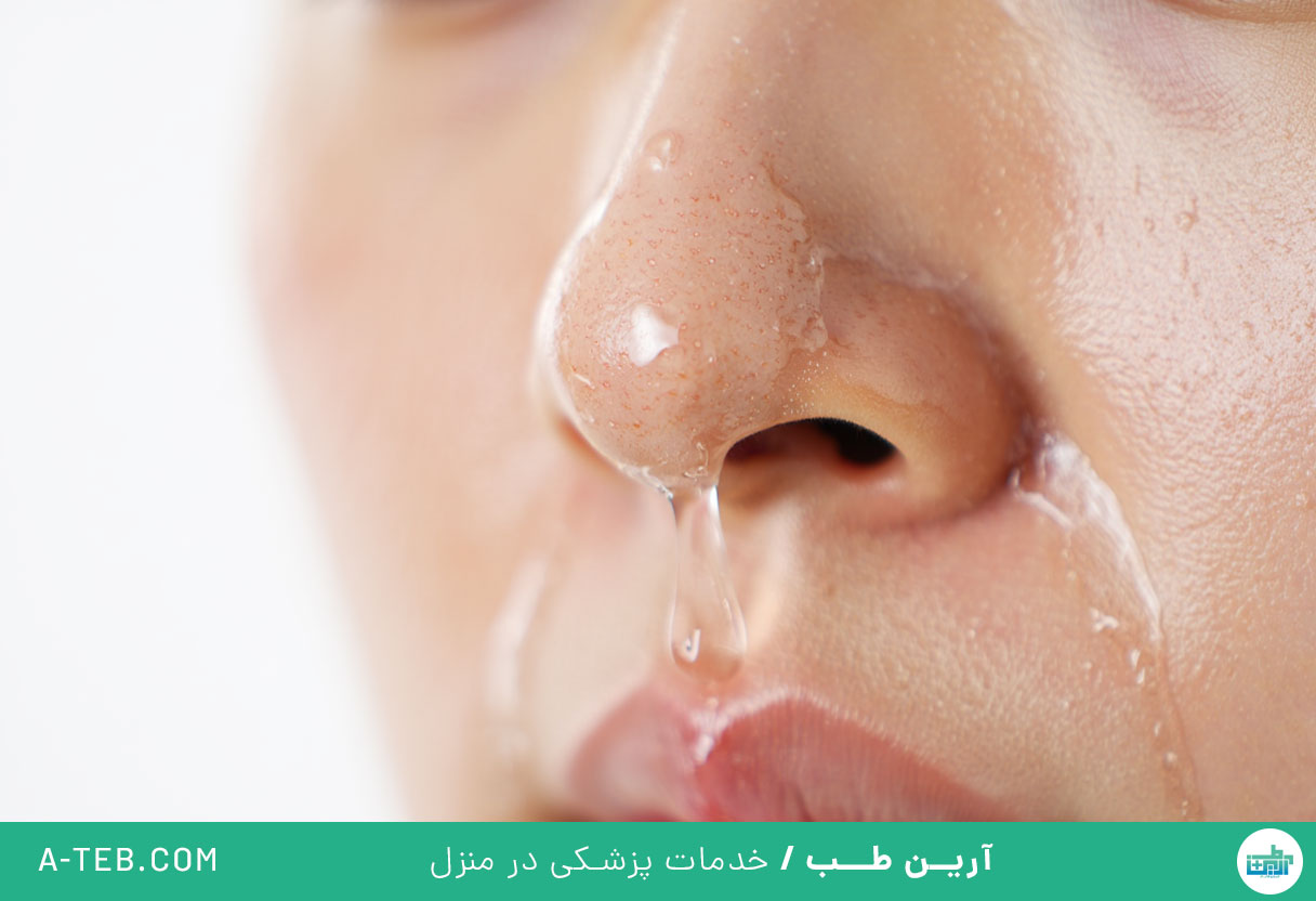 آبریزش بینی