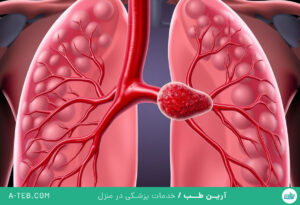 آمبولی ریوی