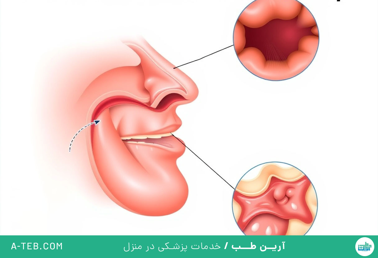 خلط پشت حلق