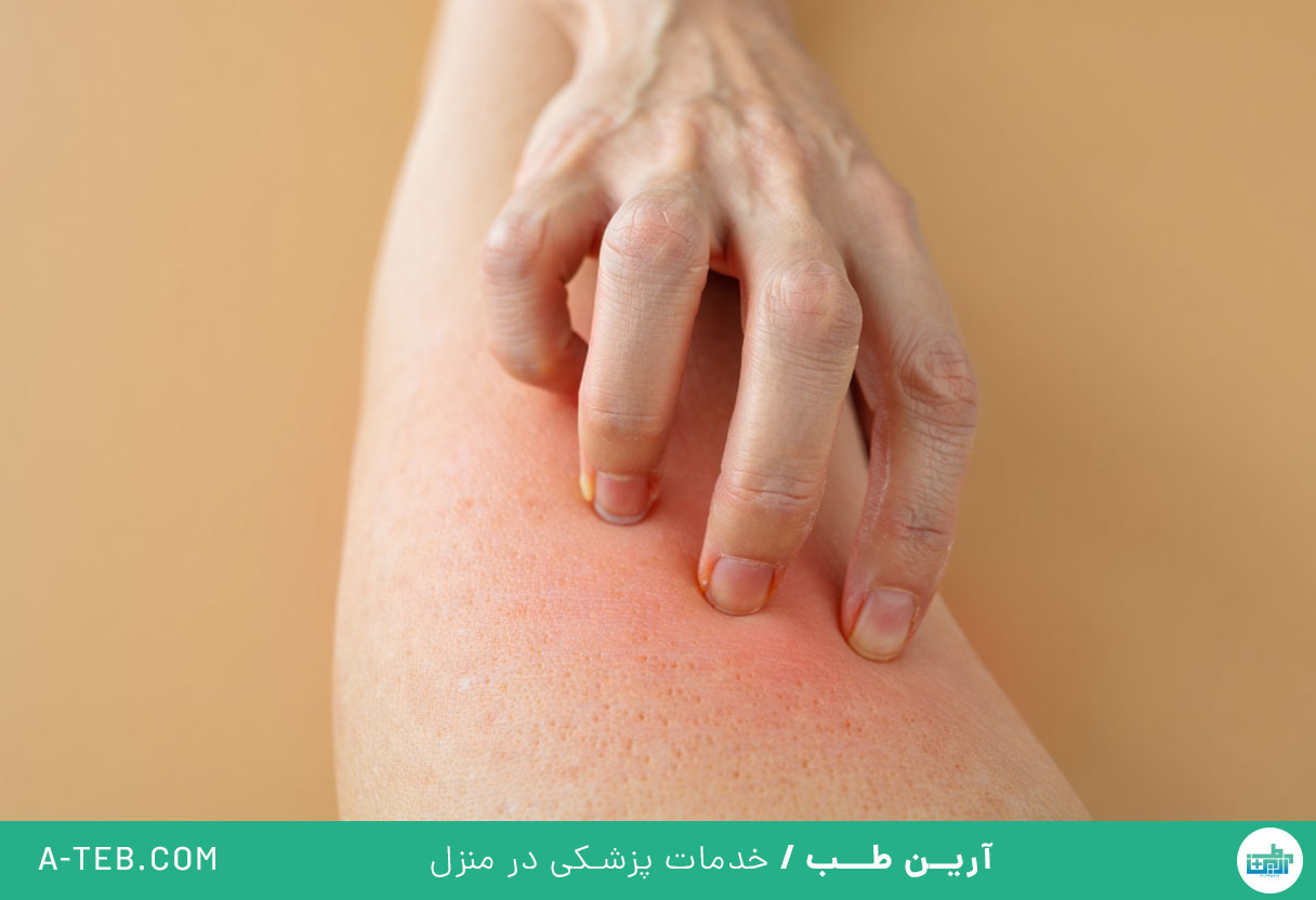 خارش بدن
