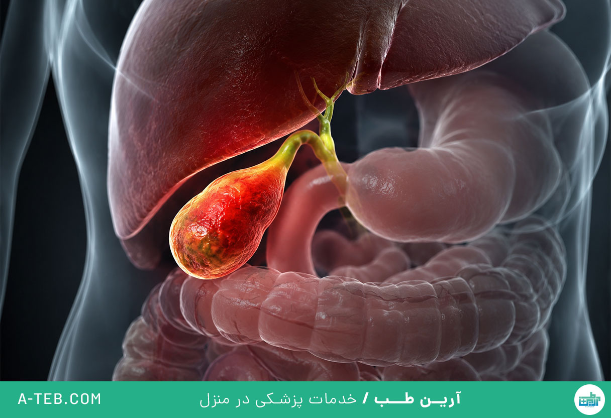 التهاب کیسه صفرا