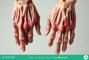 آرتریت روماتوئید