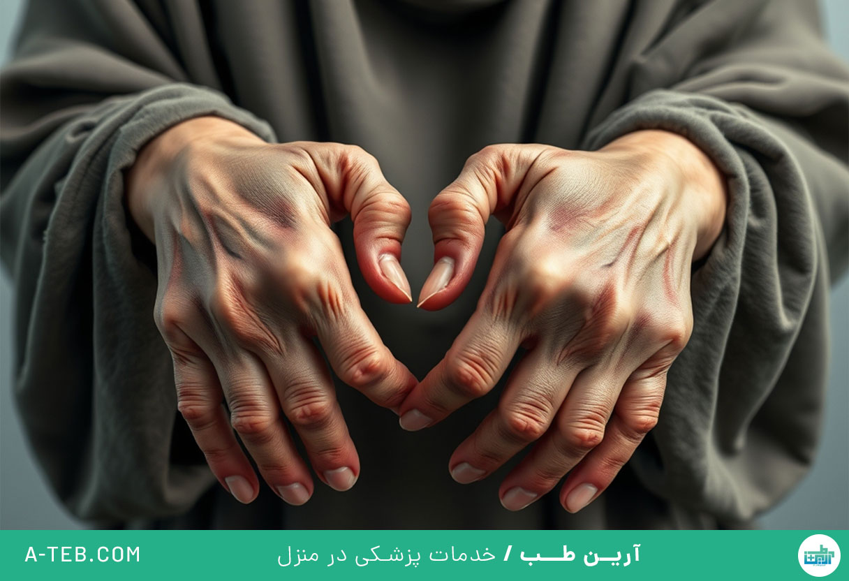 آرتریت روماتوئید