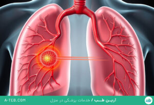 آمبولی ریوی