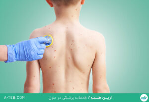 آبله میمونی