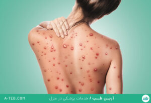 آبله میمونی