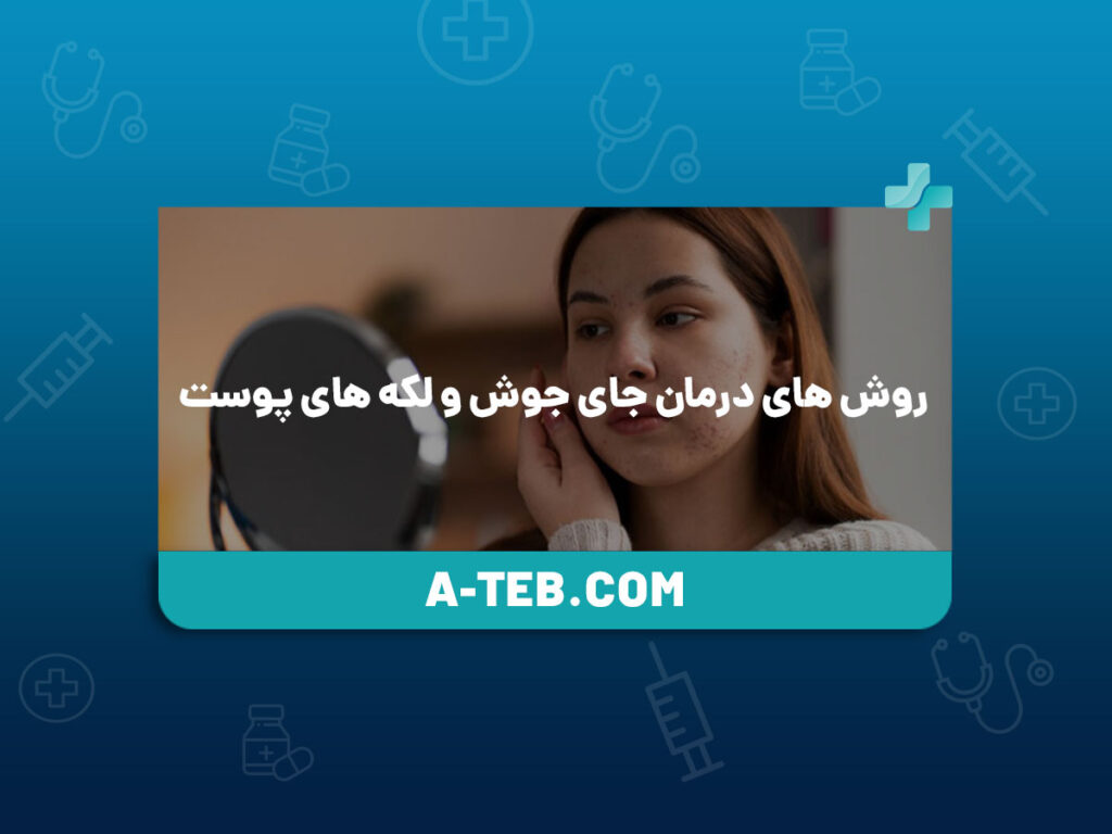 درمان جای جوش