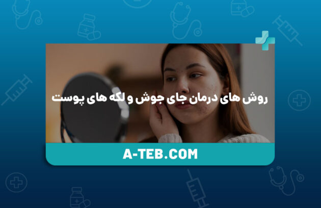 درمان جای جوش