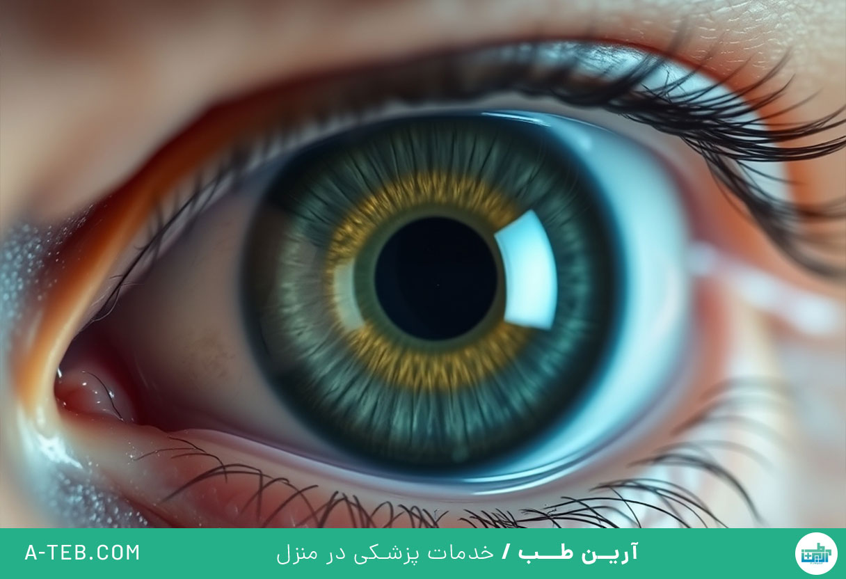 آب مروارید