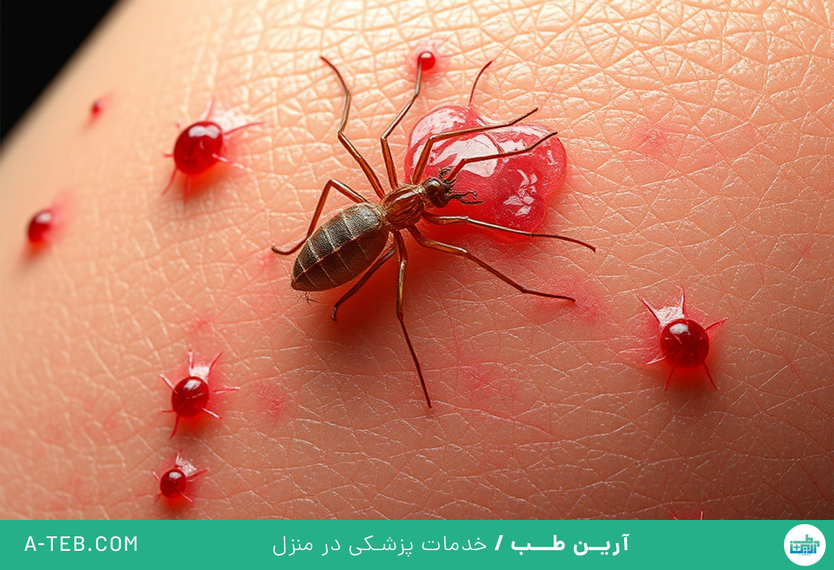 نیش حشرات