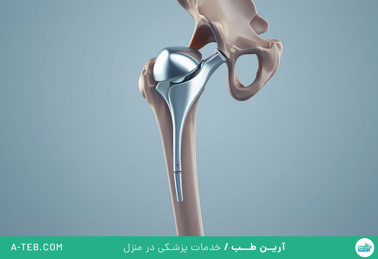جراحی تعویض مفصل فمور