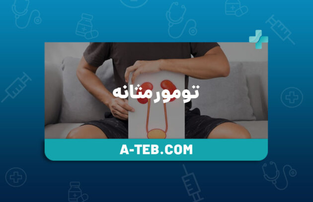 تومور مثانه