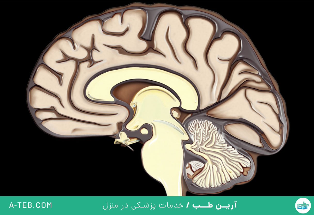 سکته مغزی بزرگ