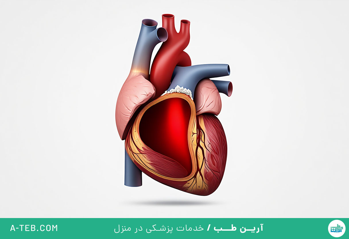 تنگی دریچه آئورت