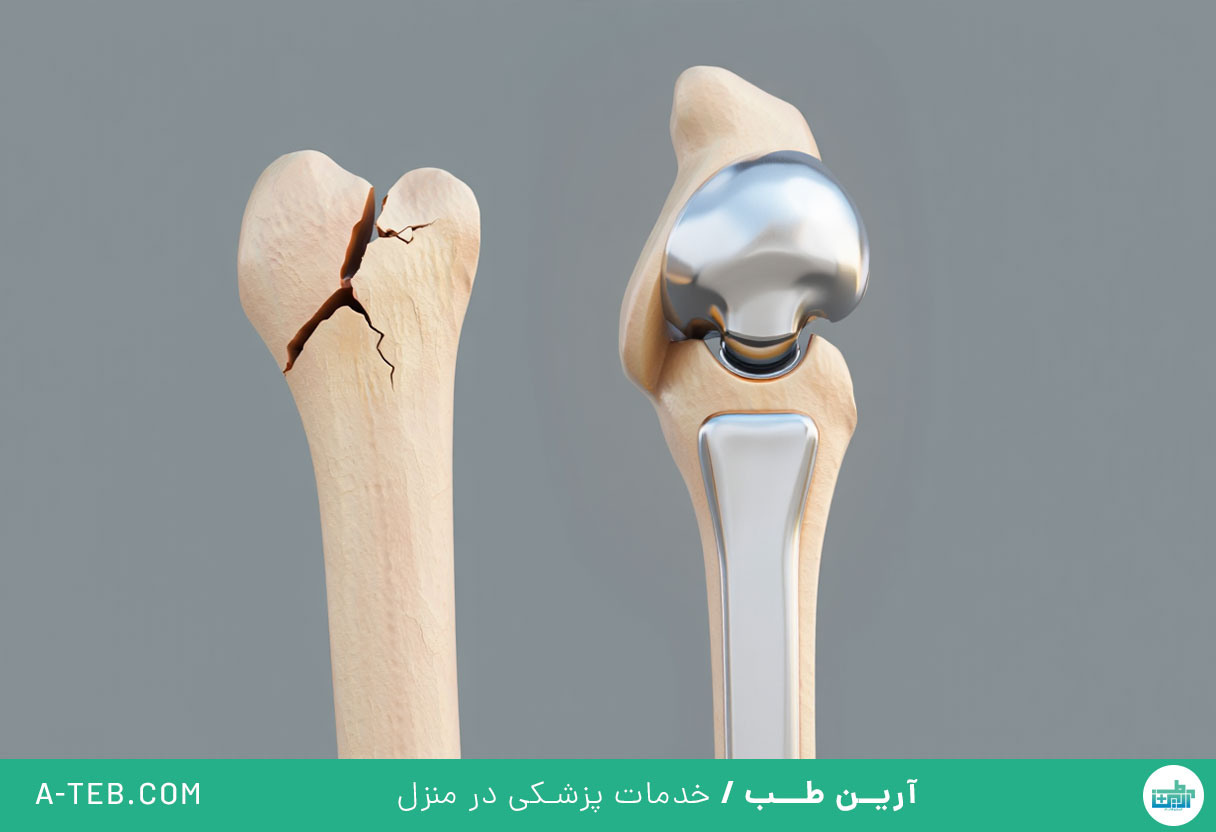 جراحی تعویض مفصل فمور