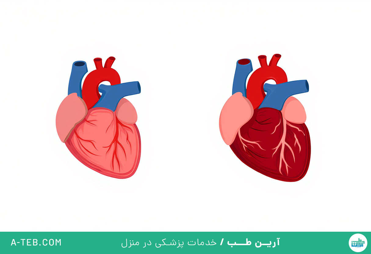 هیپرتروفی قلب