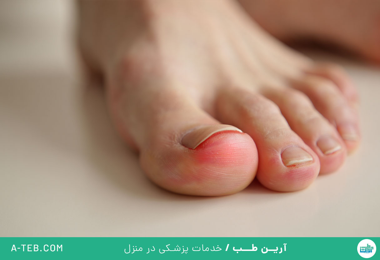 فرو رفتن ناخن در گوشت پا