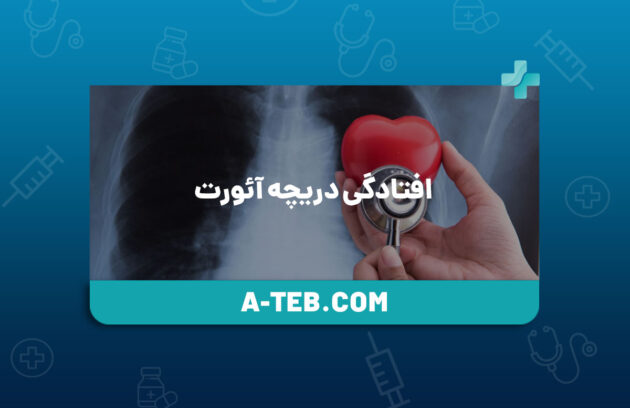 افتادگی دریچه آئورت