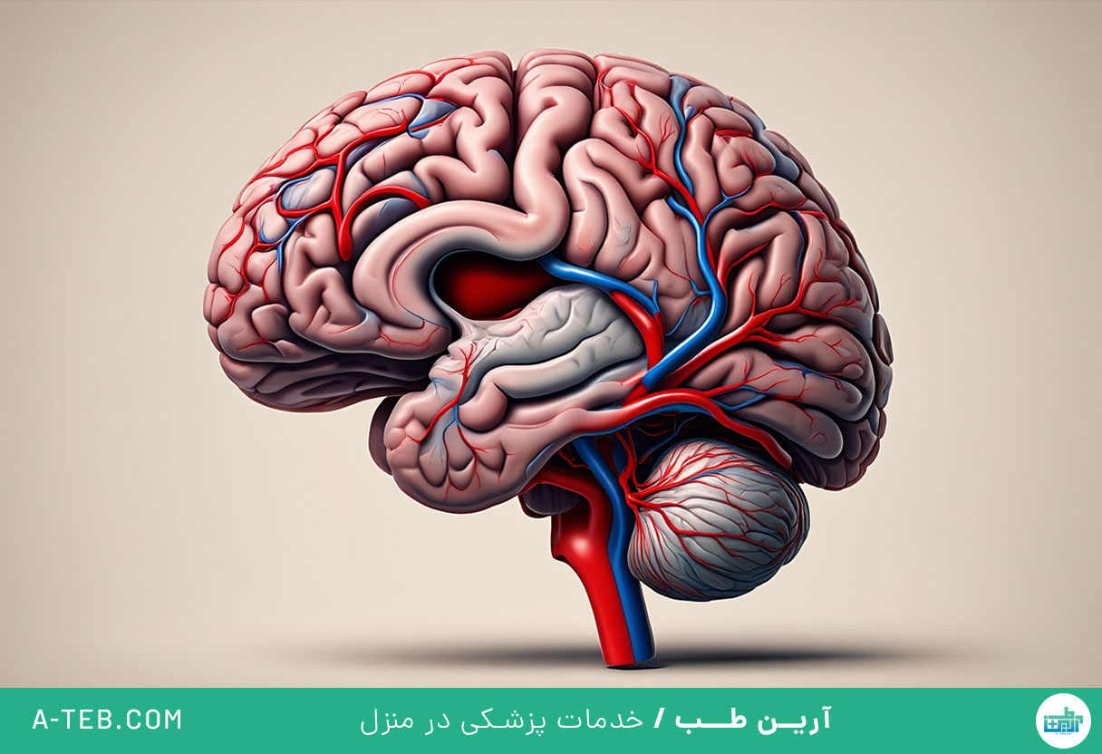 سکته مغزی بزرگ