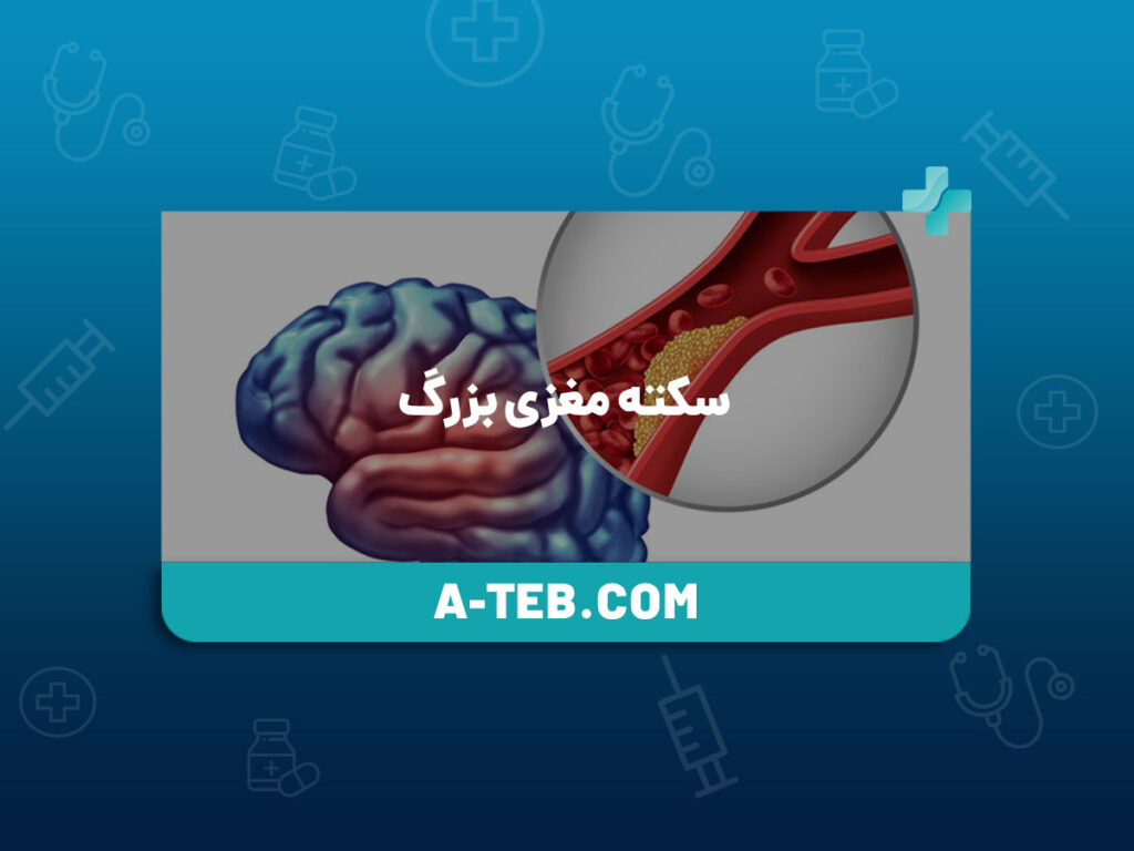 سکته مغزی بزرگ