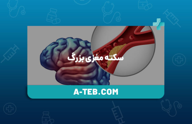 سکته مغزی بزرگ